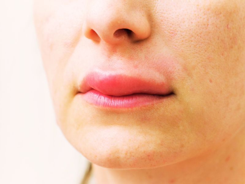 labio inchado